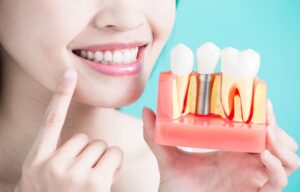The 10 answers to your questions about dental implants