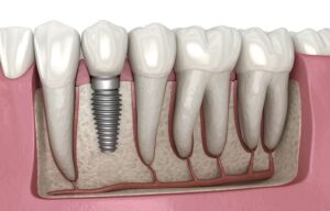 Better than the original – Everything you need to know about dental implants
