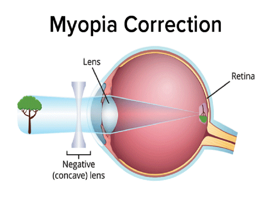 Correct Myopia