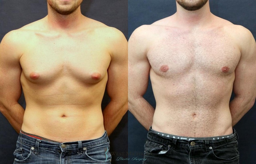 gynecomastia surgery